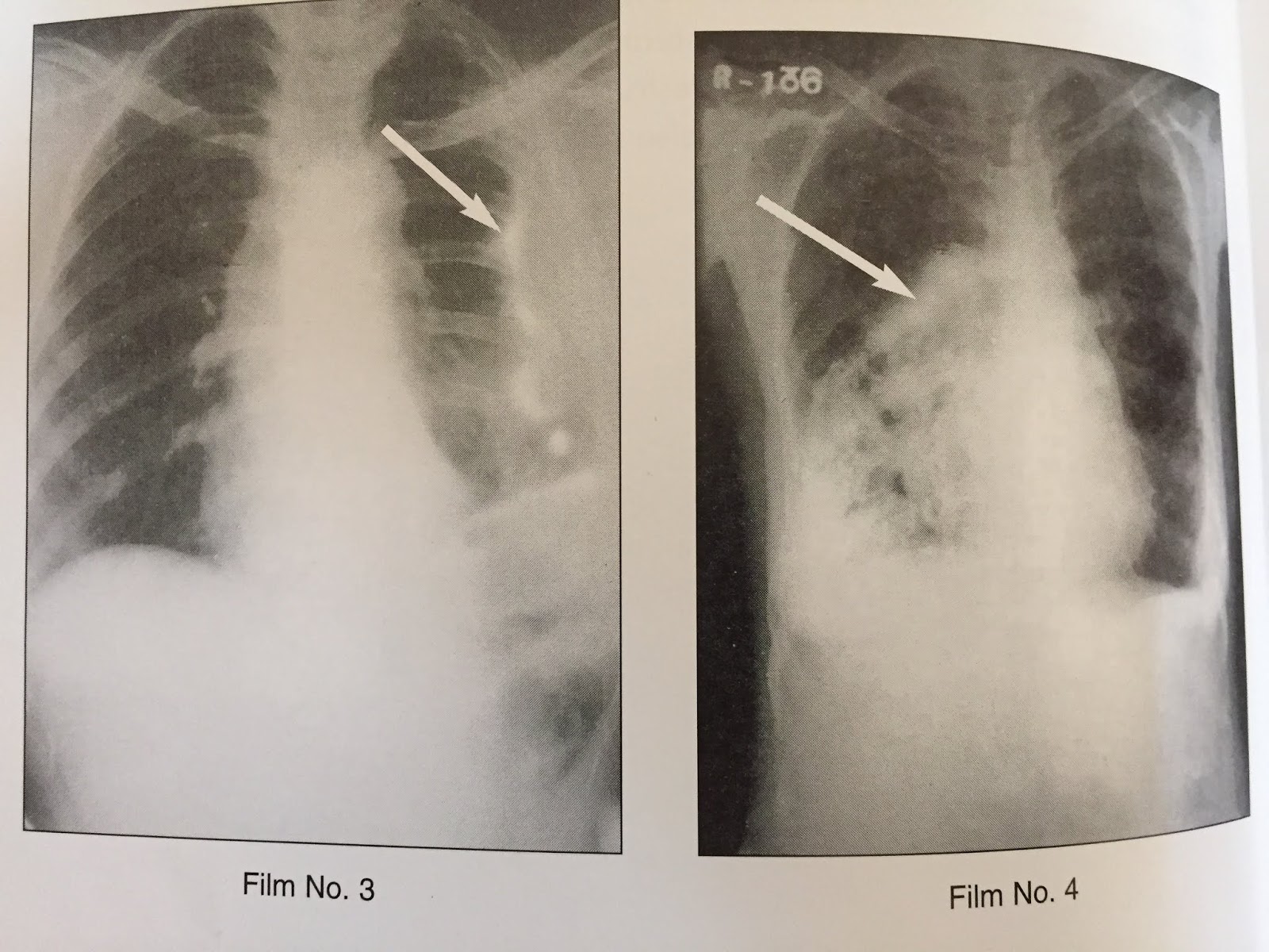 XRAYS OF PLEURAL CALCIFICATION