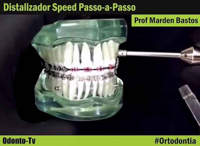 ORTODONTIA: Distalizador Speed Passo-a-Passo - Prof Marden Bastos