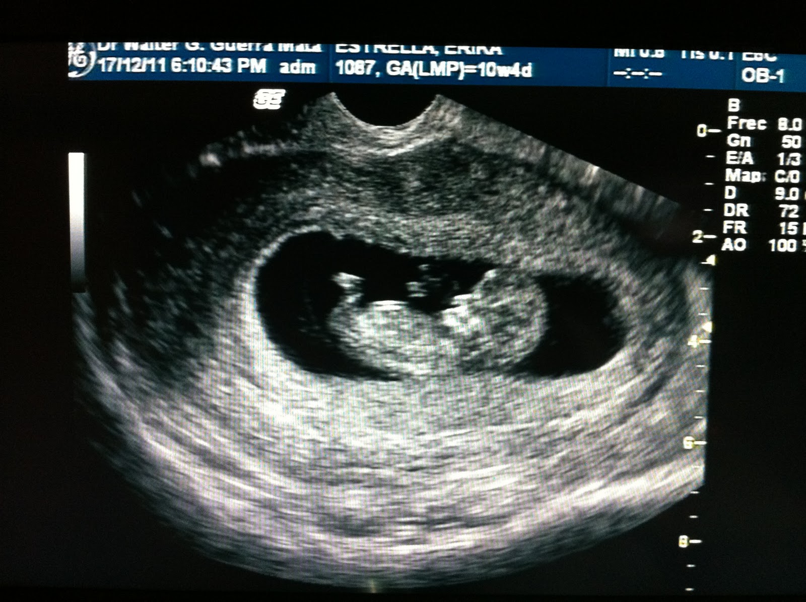 Gynesure ULTRASONIDO