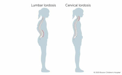 LORDOSIS