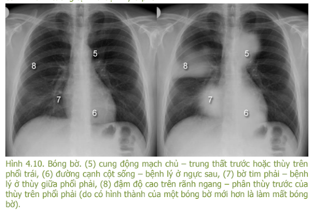 Ebook X quang ngực trong thực hành lâm sàng