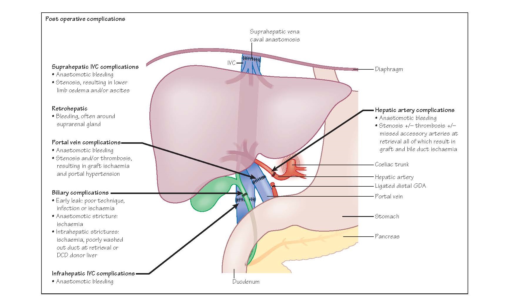 Complications Of Liver Transplantation