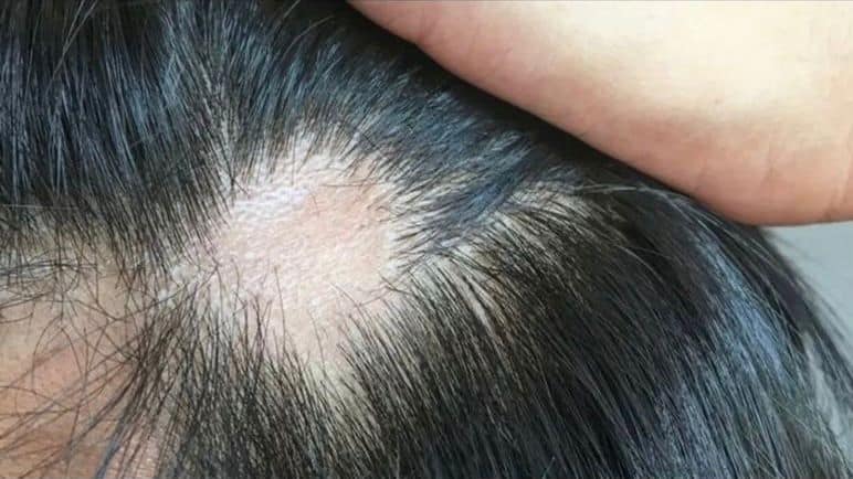 A queda de cabelos em pacientes acometidos pela Covid-19 tem levado homens e mulheres de todas as idades aos consultórios de dermatologia. “Nos últimos três meses, observamos um aumento de 80% nos atendimentos de casos de alopecia associados à doença”, afirma a dermatologista Anelise Dutra.