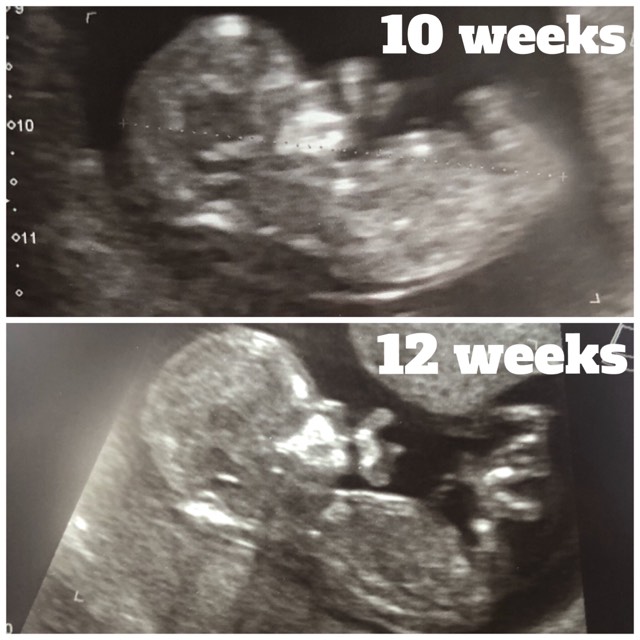 12 Weeks Pregnant - NT Baby (Cystic Hygroma Happy Ending)