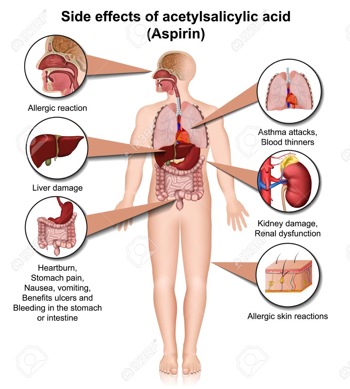 Aspirin Uses, mechanism of action, side effects, preparations. be