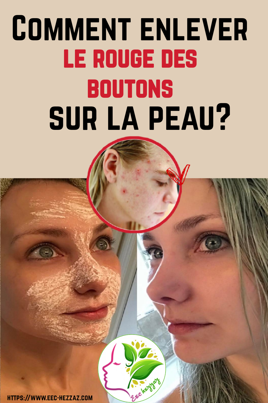 Comment enlever le rouge des boutons sur la peau?