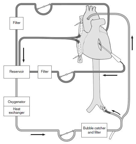 Management of a Patient on Cardiopulmonary Bypass Machine Case File