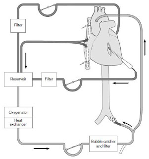 Management of a Patient on Cardiopulmonary Bypass Machine