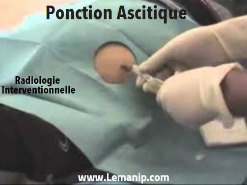 Préparation Avant la ponction ascitique