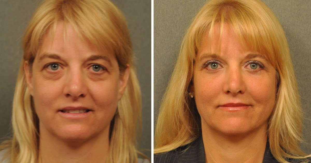 Getting Your NonInvasive Facelift By Employing Facial Workouts Ever