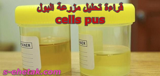 قراءة تحليل مزرعة البول cells pus