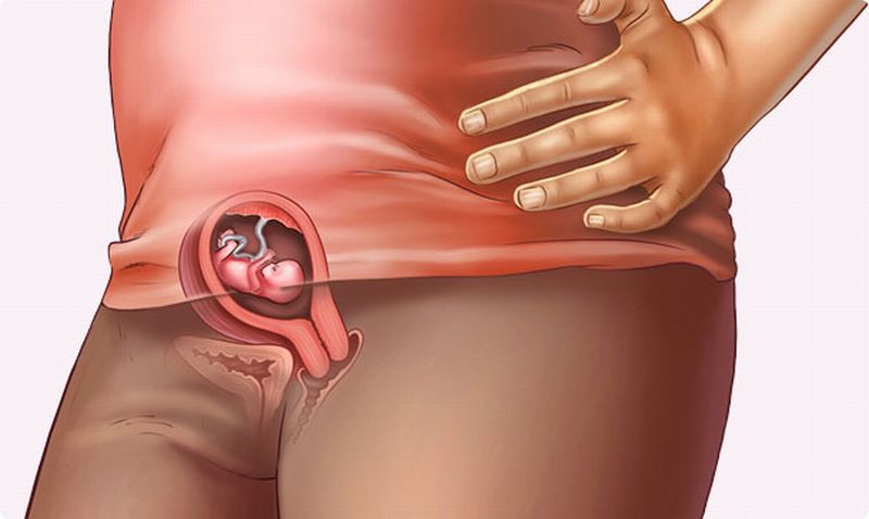 أعراض الحمل خارج الرحم أعراض الحمل خارج الرحم