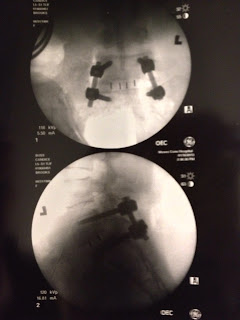 X-rays of my lumbar hardware. Image has two parts, the first is a front view of the hardware showing the four screws and two rods along with black lines to show the cage.  The bottom view is a side view showing the depth of the screws.