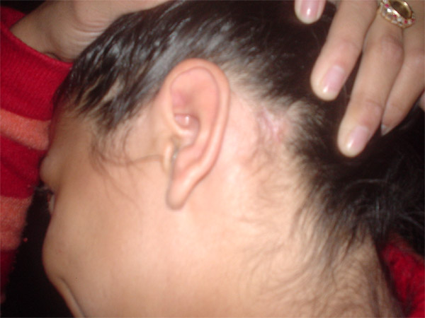 Painful Bumps on the Scalp - Buzzle