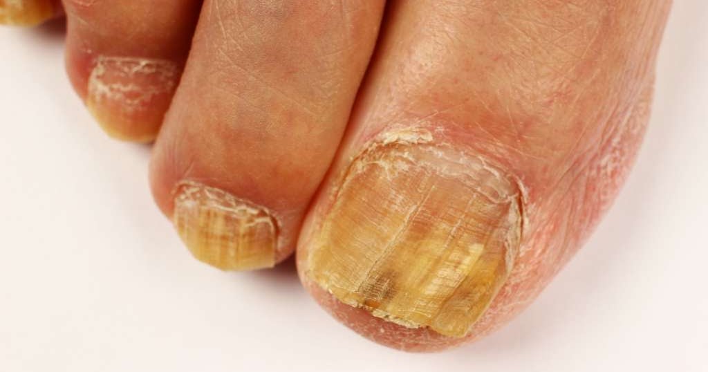 Mycose des ongles Nos Conseils de Vie