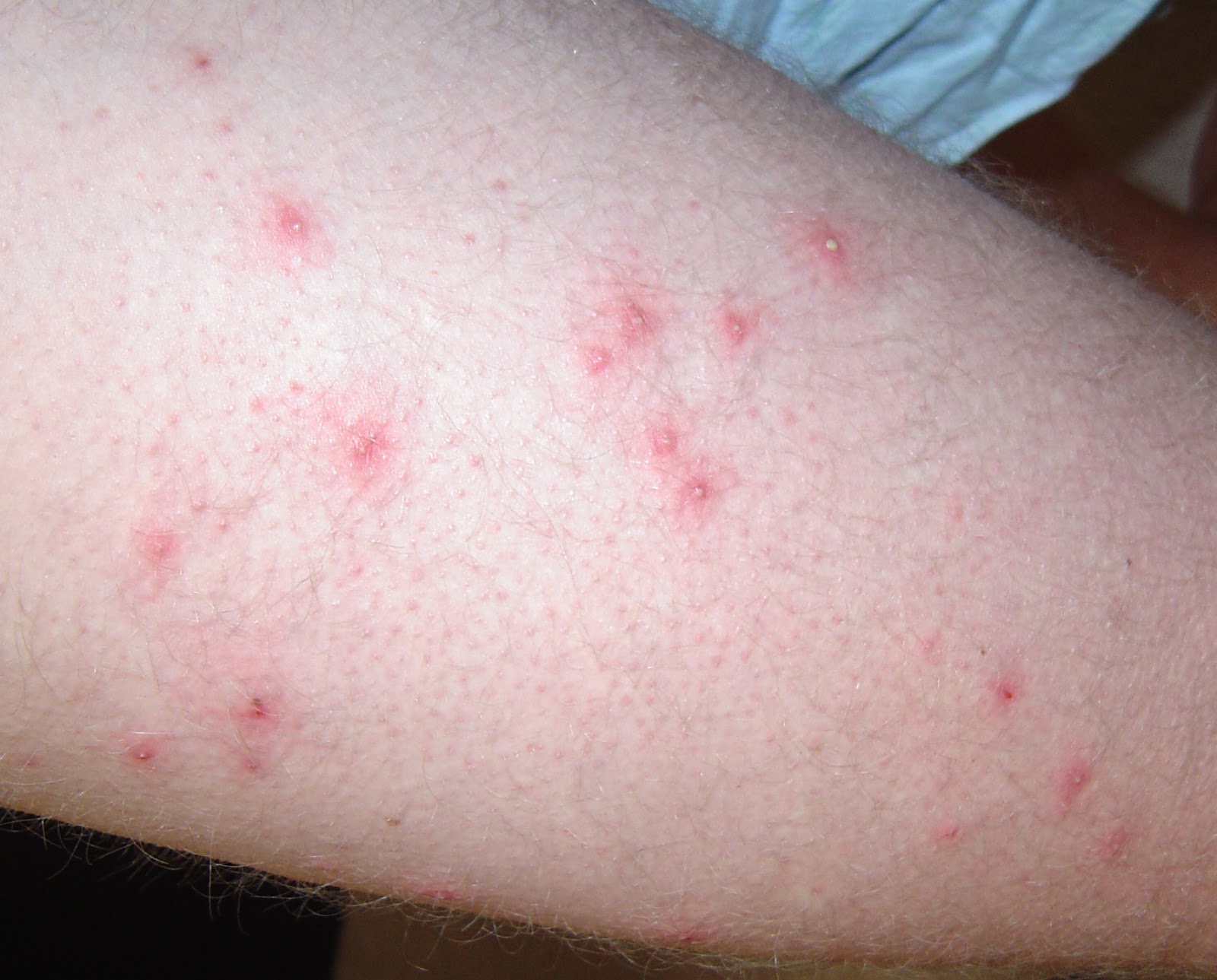 over the counter staph infection