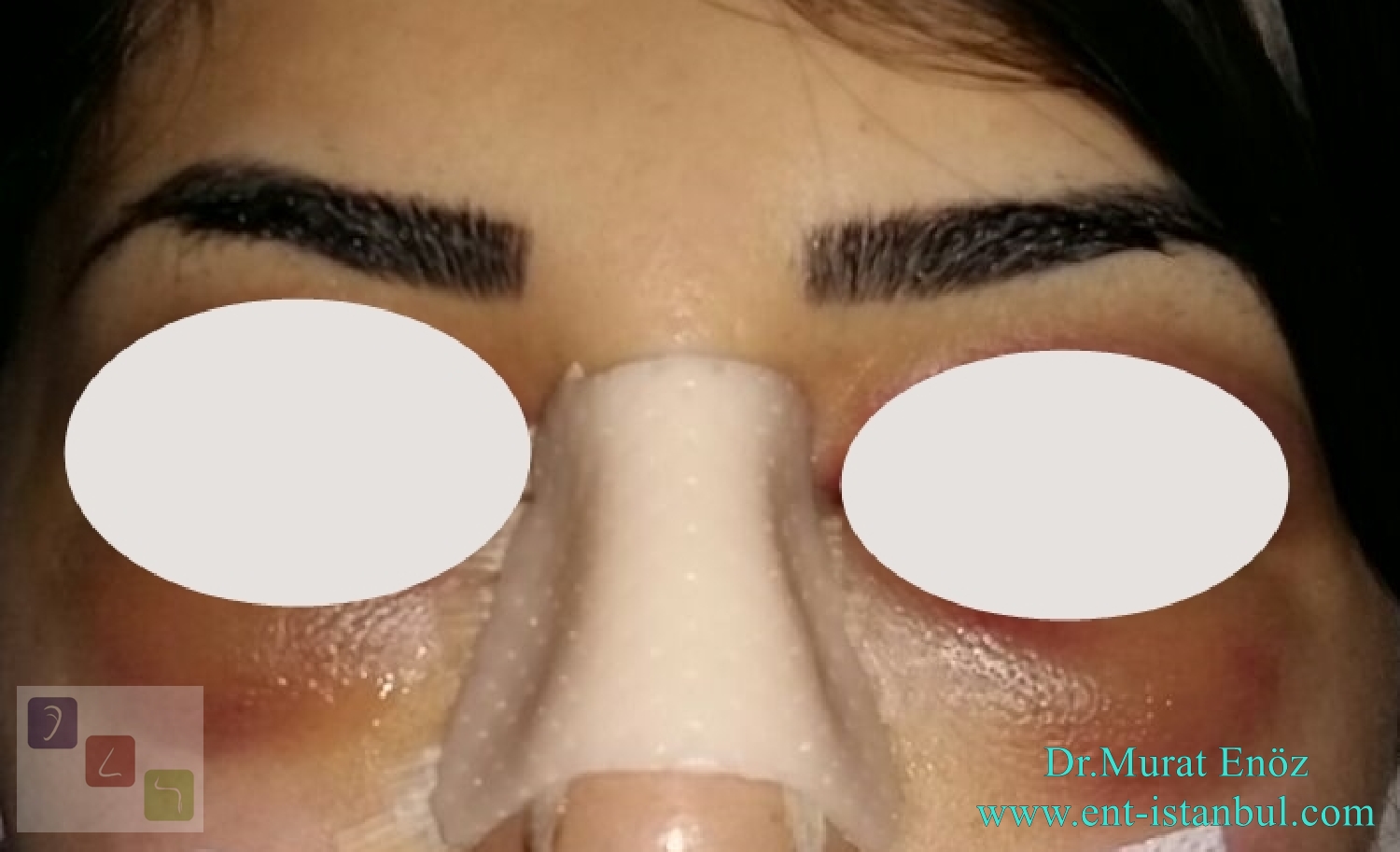 Health Zone Turkey How to Reduce Bruising and Swelling After Nose Job?