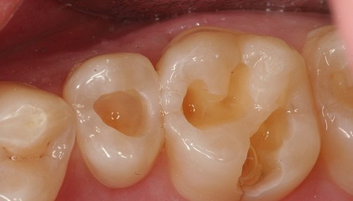 5 Bahan Alami Untuk Mengobati Gigi Berlubang Paling Ampuh