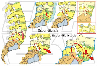 Inestabilidad lumbar: espondilolisis y espondilolistesis.