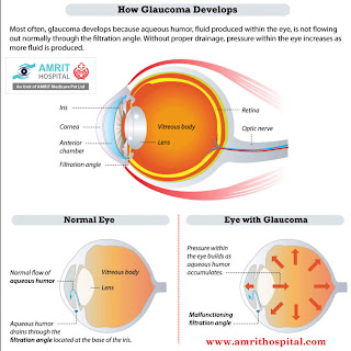 glaucom treatment chennai