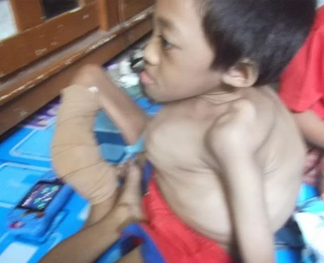 8 Fakta dari Kisah Fahri (11th), Anak yang Setiap Batuk Tulangnya Selalu Patah