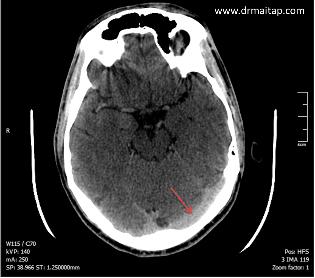 hemorragia subaracnoidea occipital