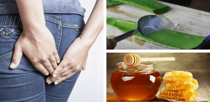 remedios para aliviar las hemorroides