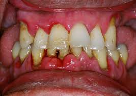 Dr. Yogesh: Gum Disease