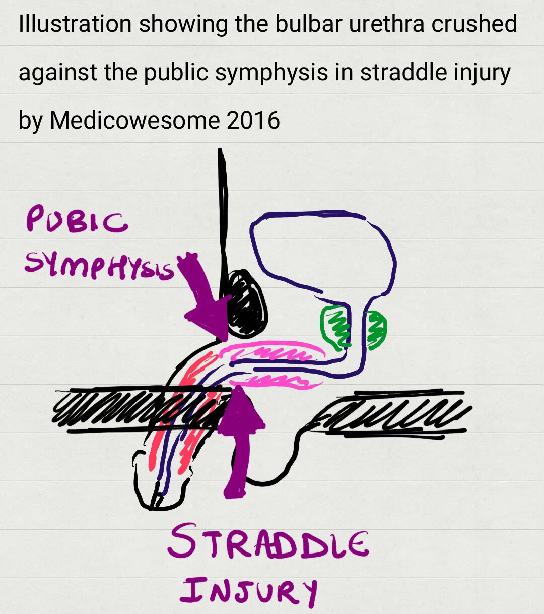 Medicowesome Step 2 CK Anterior and posterior urethral injuries and