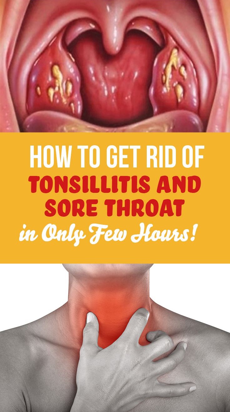 How To Get Rid Of Tonsillitis And Sore Throat In Only Few Hours