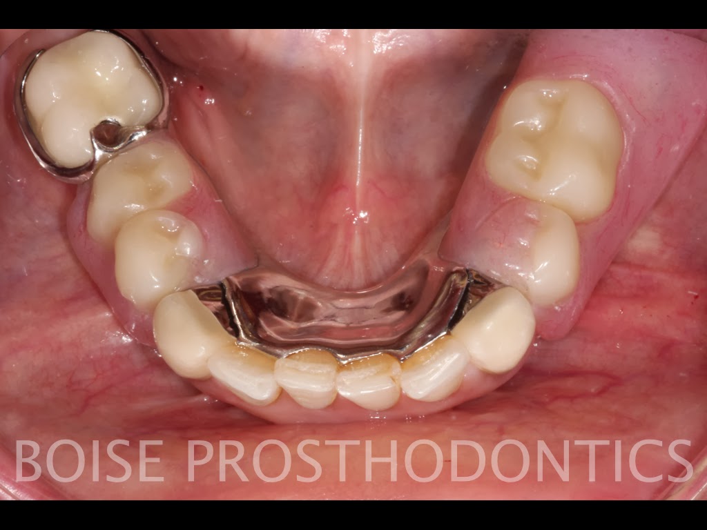 Boise Idaho Prosthodontics Maxillary Teeth and Mandibular Semiprecision Removable Partial