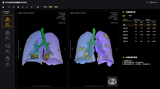 HUAWEI CLOUD Launches AI-Assisted Diagnosis for COVID-19, Outputting CT Quantification Results in Seconds