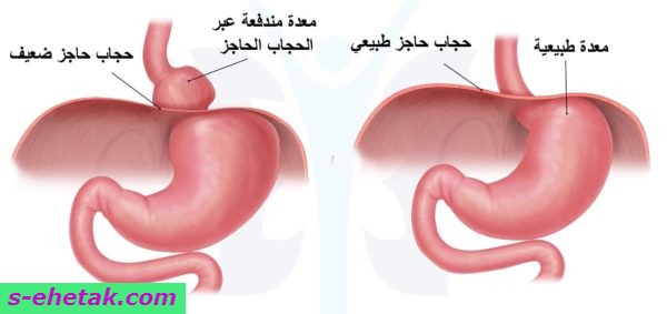 علاج فتق الحجاب الحاجز بالأعشاب