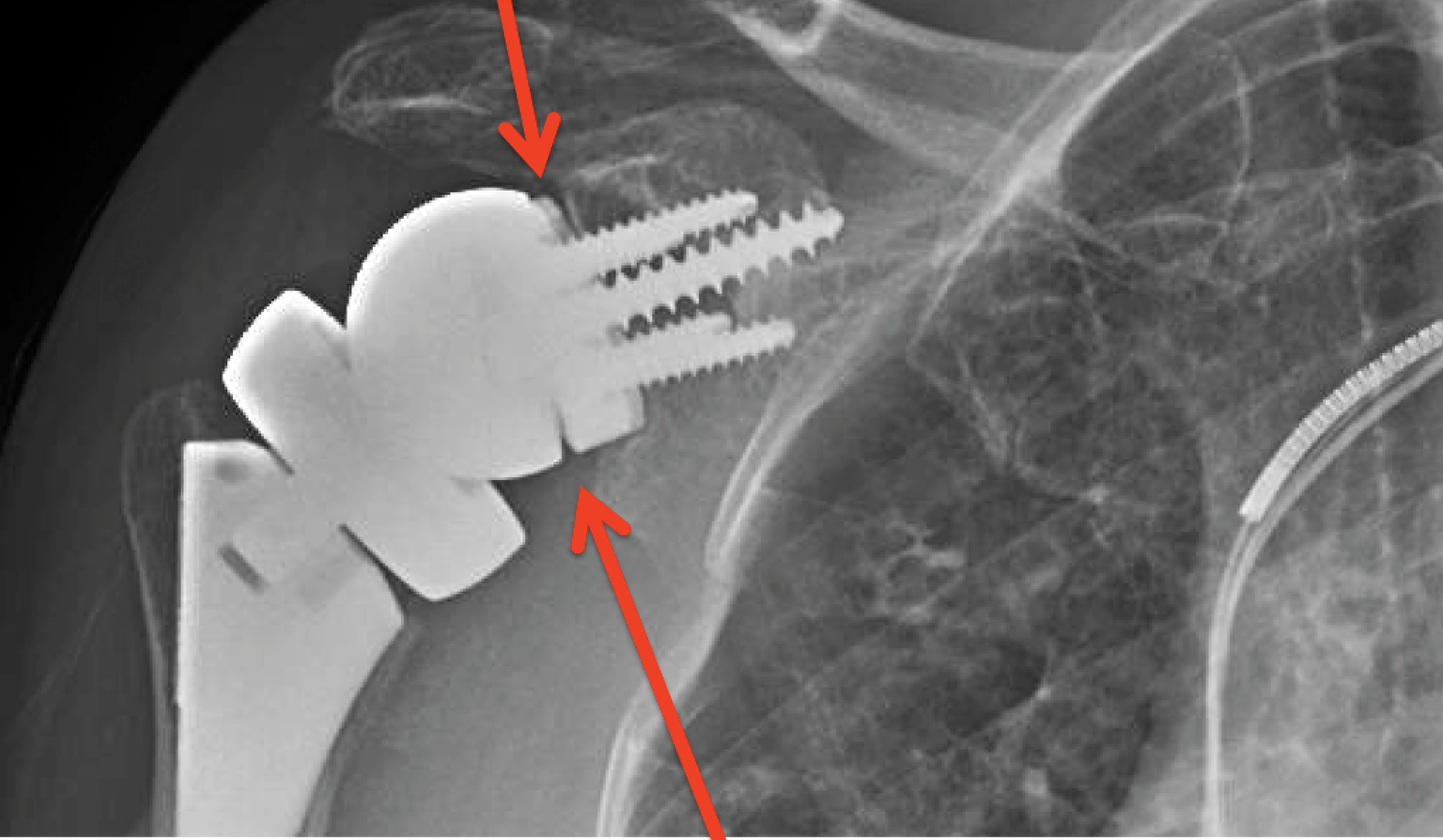 UW Shoulder and Elbow Academy Reverse total shoulder why take xrays