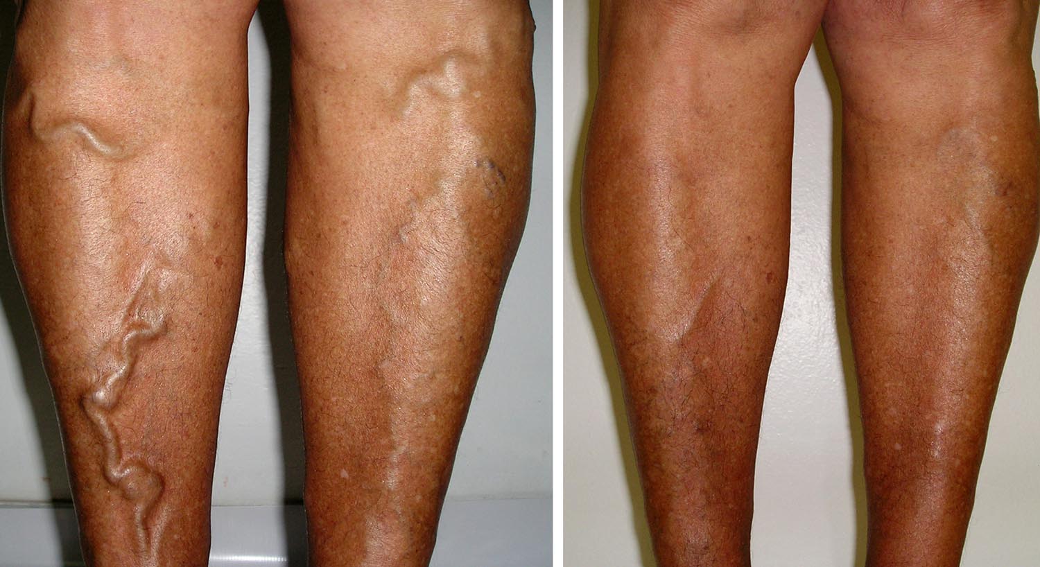 Procedimento Para Desentupir Veias Da Perna VARIZES