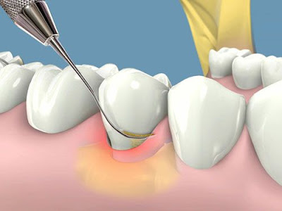 Quy trình cạo vôi răng tại nha khoa chuyên nghiệp