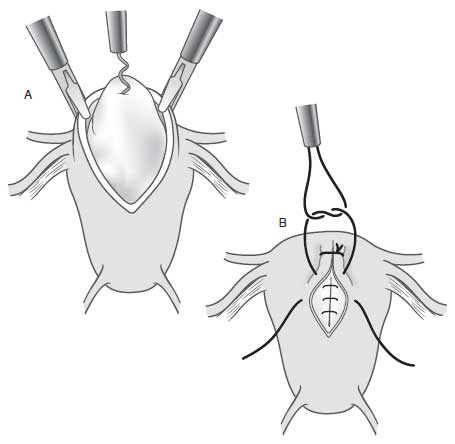 Uterine Leiomyoma