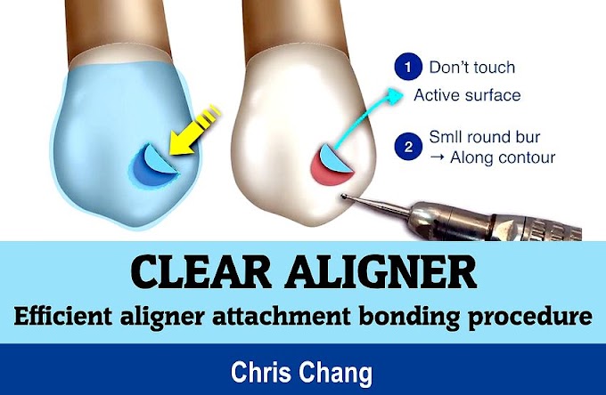 CLEAR ALIGNER: Efficient aligner attachment bonding procedure - Chris Chang