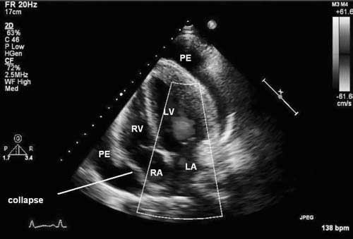 Large pericardial effusion