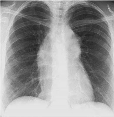 PA Chest x-ray