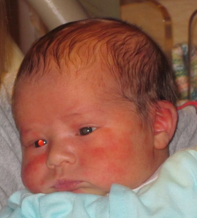 Tommy's Eyes Red Reflex