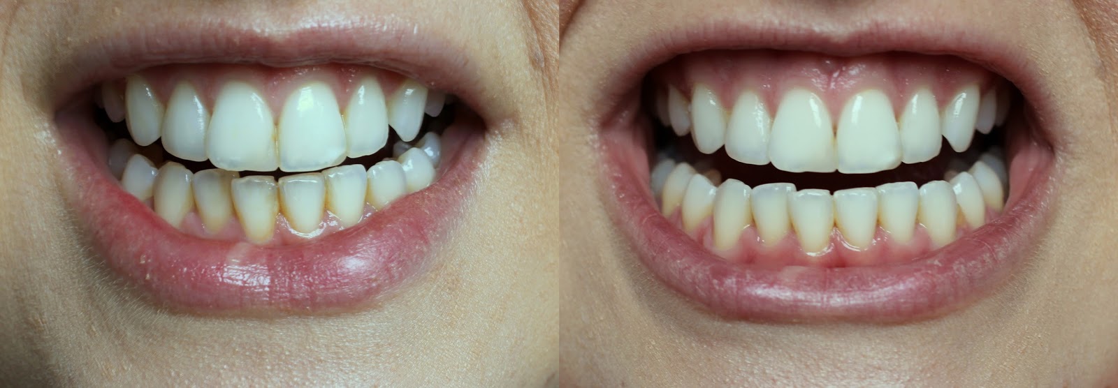 Review Pola Teeth Whitening At Knightsbridge Dental Care The Beauty