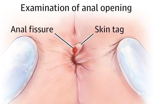 Anal Fissures What Is A Fissure