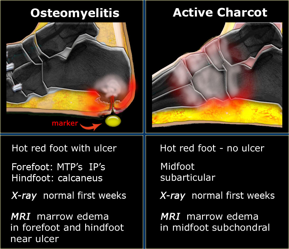 MRI MusculoSkeletal Section Active osteomyelitis versus active charcot.