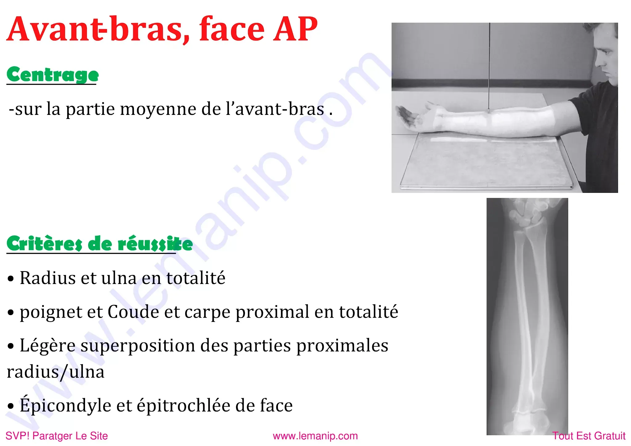 Avant bras face