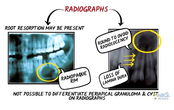 RADICULAR CYST: Clinical features, radiology and histopathology