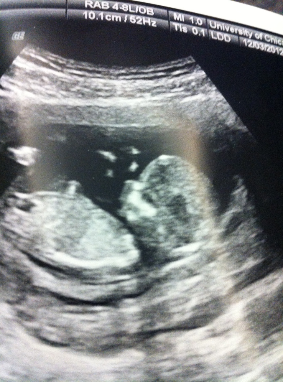 Image 12 Week Ultrasound