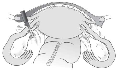 utero-ovarian ligament