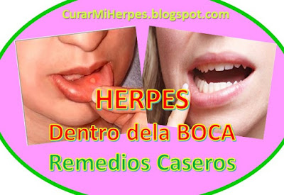 herpes-bucal-dentro-dela-boca-tratamiento-remedios-caseros