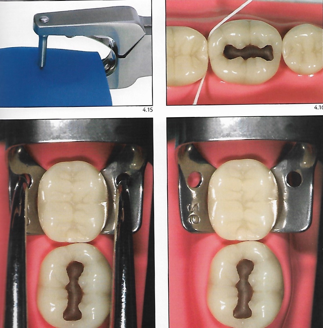 Rubber dam isolation in the posterior segment Dental Esthetics